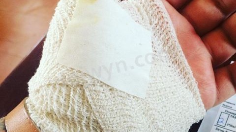 Bandaged Hand